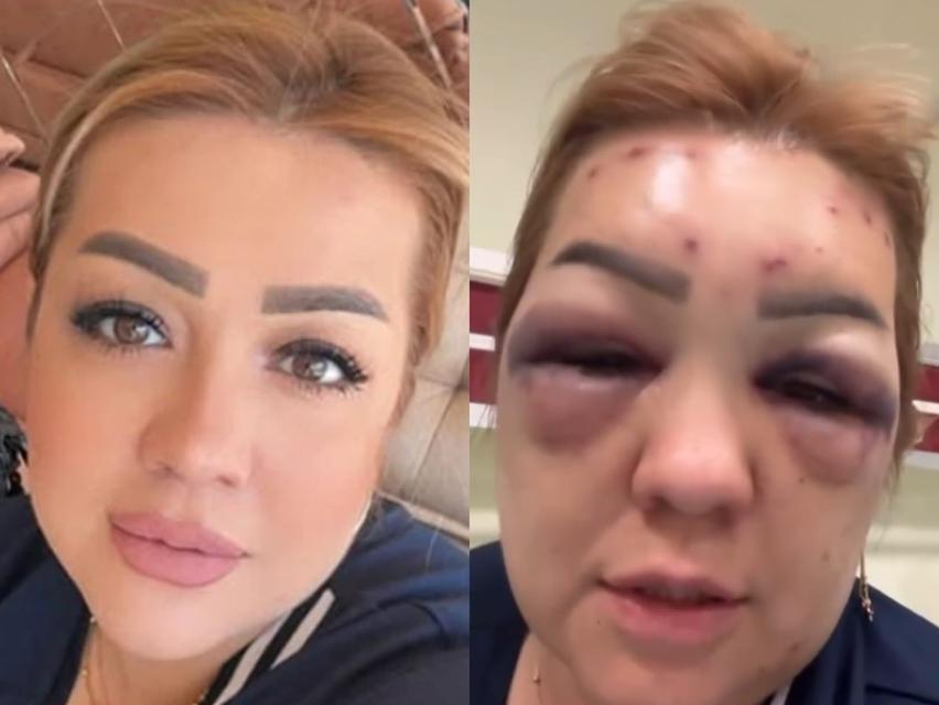 BOTOKS BU HALE GETİRDİ: YÜZÜ ŞİŞTİ TANINMAYACAK HALE GELDİ BOTOKS MAĞDURU KADIN: "SİZ DE BİLMEDİĞİNİZ HİÇBİR YERE GİTMEYİN, DOKTOR HARİCİ KİMSEYE YAPTIRMAYIN ARKADAŞLAR"