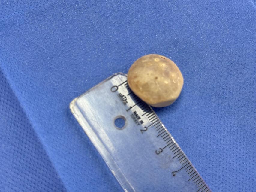 VÜCUDUNDAN 287 TANE TAŞ ÇIKARILDI, DOKTORLAR BİLE ŞOK OLDU: "LİTERATÜRDE ÇOK NADİR GÖRÜLEN BİR OLAY" KARIN AĞRISIYLA DOKTORA GİTTİ, VÜCUDUNDAN 287 TANE TAŞ ÇIKARILDI UZMANLAR: "BİZ DE O KADAR TAŞ BEKLEMİYORDUK, ÇOK ŞAŞIRDIK"